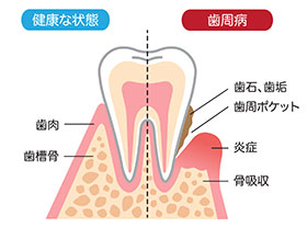 歯周ポケット